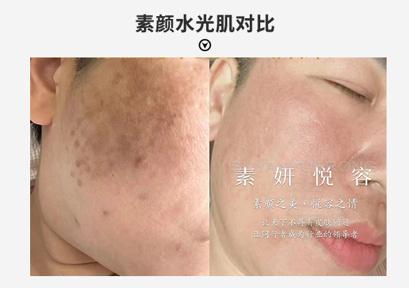 Melasma before after