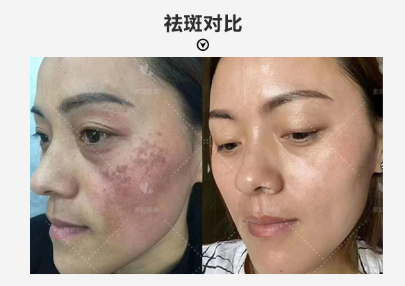 Freckle before after